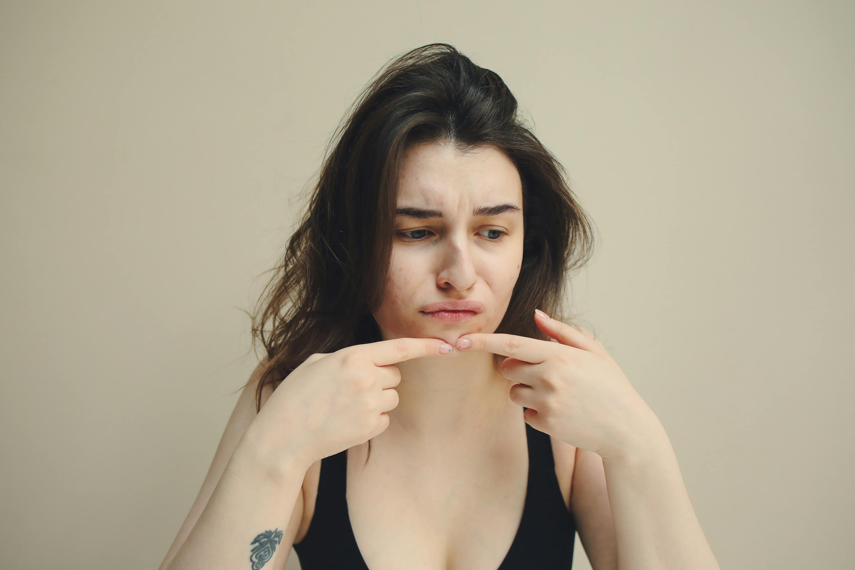 How to Handle a Pimple Before the Wedding Day